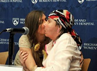 Carmen Tarleton after her face transplant 