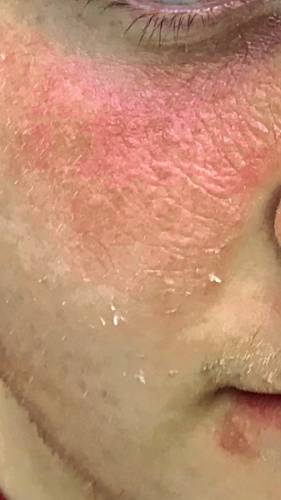 creosote burns