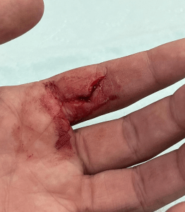 a cut on a hand with blood around it